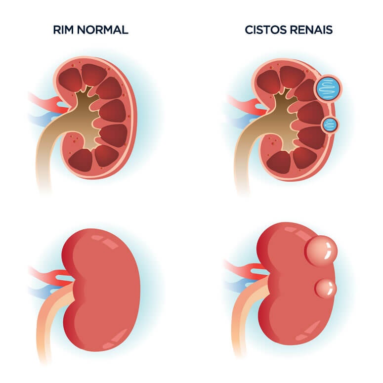 Cistos-renais.jpg